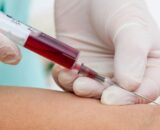 Exame de sangue que pode detectar mais de 50 tipos de câncer chega ao Brasil