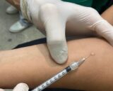 Teste tuberculínico chega a 55 unidades de saúde em Manaus