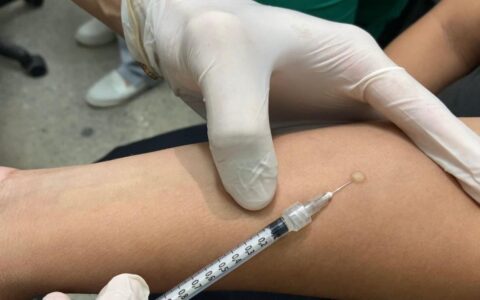 Teste tuberculínico chega a 55 unidades de saúde em Manaus